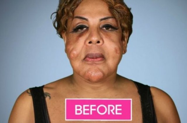 O femeie si-a injectat ciment in propria fata. Schimbarea care a urmat este incredibila