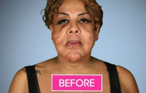 O femeie si-a injectat ciment in propria fata