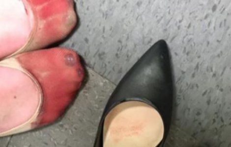 Cum arata picioarele unei chelnerite obligate sa poarte tocuri