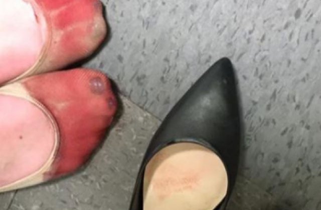 [FOTO] Cum arata picioarele unei chelnerite dupa o zi de munca in care a fost obligata sa poarte tocuri