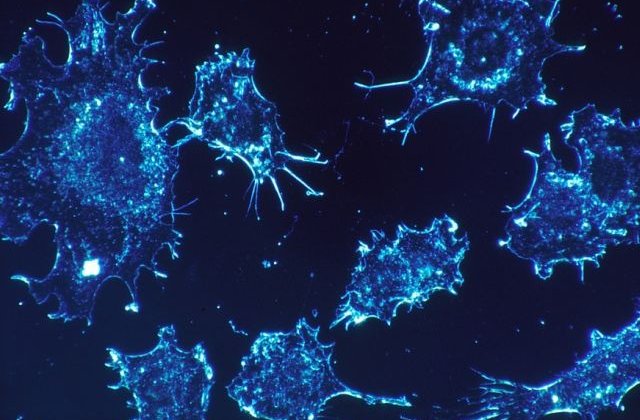 Cancerul unei persoane poate fi tratat cu ajutorul celulelor imunitare imprumutate de la altcineva