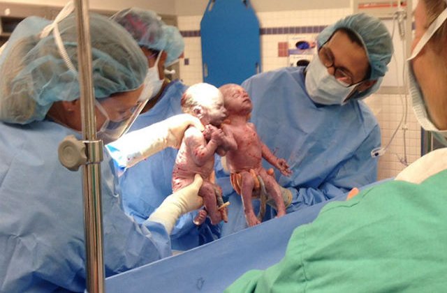 [FOTO] Povestea gemenelor care s-au nascut tinandu-se de mana si sunt in continuare de nedespartit