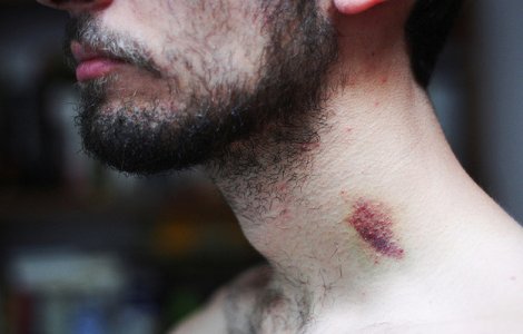 Tanar de 17 ani, mort in urma unei muscaturi din partea iubitei