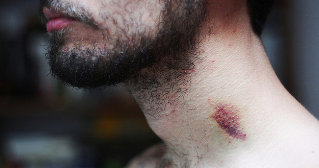 Tanar de 17 ani, mort in urma unei muscaturi din partea iubitei