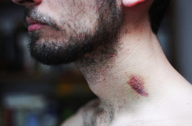 Tanar de 17 ani, mort in urma unei muscaturi din partea iubitei