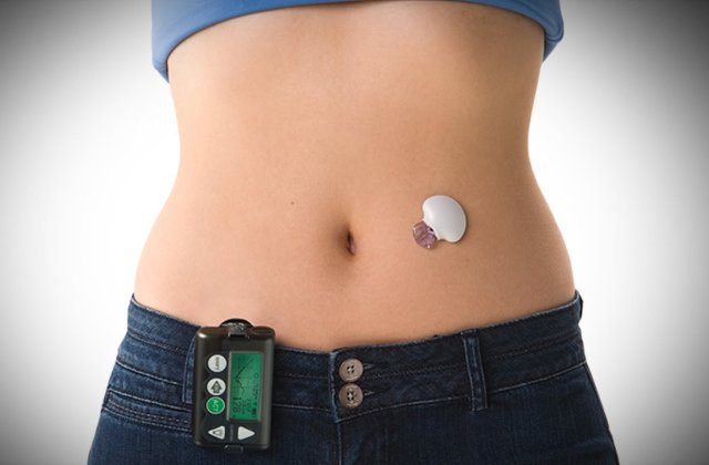 Veste buna pentru diabetici: Va fi pus in vanzare primul pancreas artificial