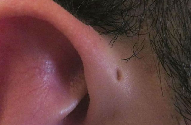[FOTO] Motivul pentru care unii oameni se nasc cu gauri mici pe urechi