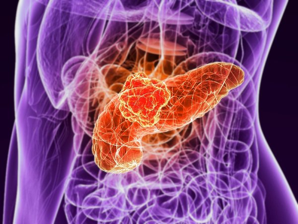 10. Cercetarile in chimioterapie au marit rata de supravietuire la concerul pancreatic, de la 16% la 27%