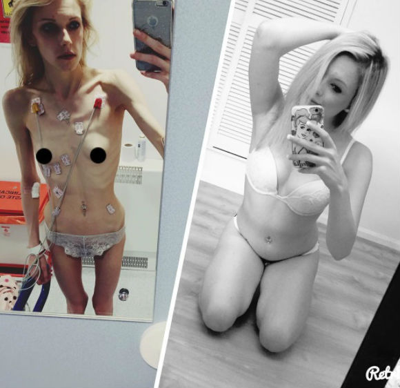 Inainte si dupa anorexie