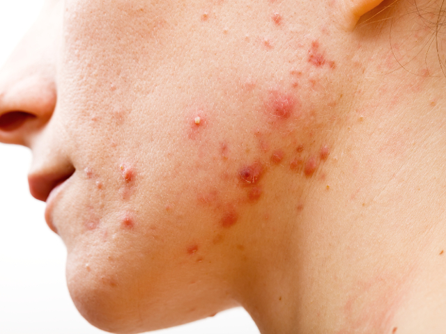 3. Probleme cu pielea