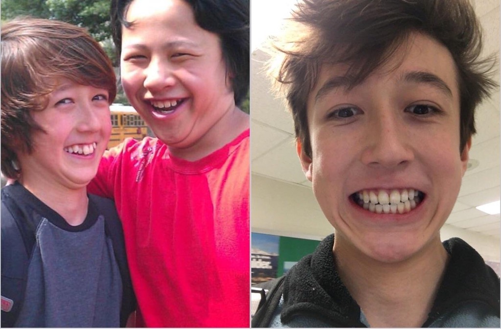 Dupa aproape trei ani de purtat aparat dentar