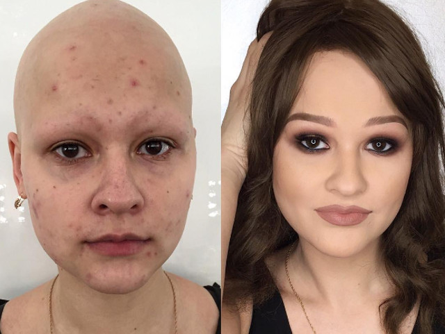 Pete, imperfectiuni si lipsa parului