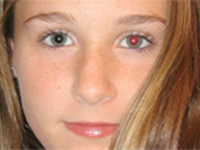 Daca o persoana are, in fotografie, un ochi normal si unul rosu, ar putea suferi de retinoblastom