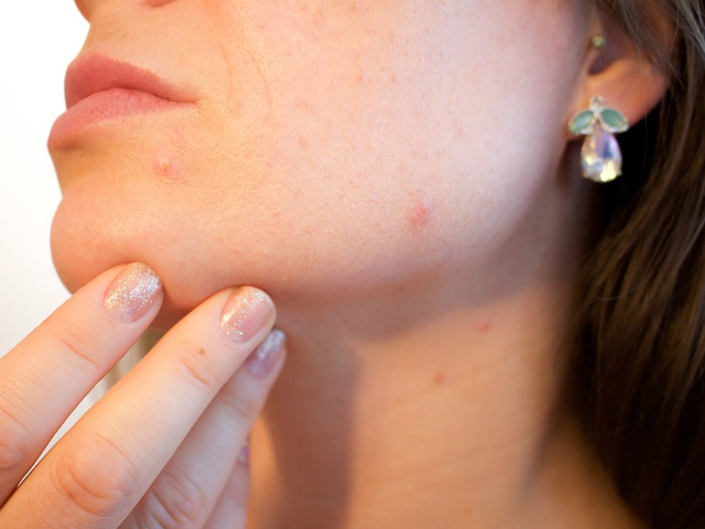 Reduce riscul aparitiei acneei