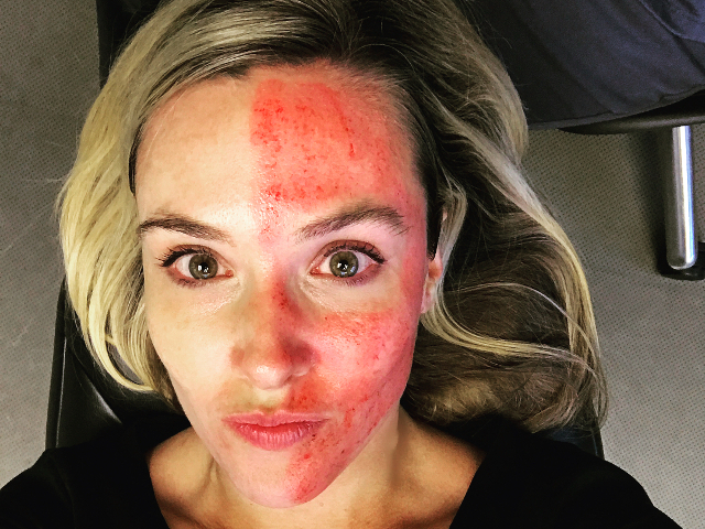 Terapie faciala "vampir"