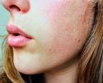 Nu folosi tratamente pentru acnee
