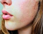 Ajuta la estomparea cicatricelor si a semnelor lasate de acnee