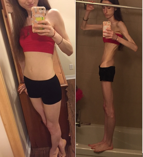 Un an diferenta si un an de lupta pentru a invinge anorexia