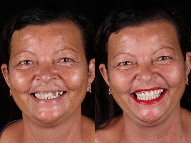 Zambetul, "terapie gratuita"