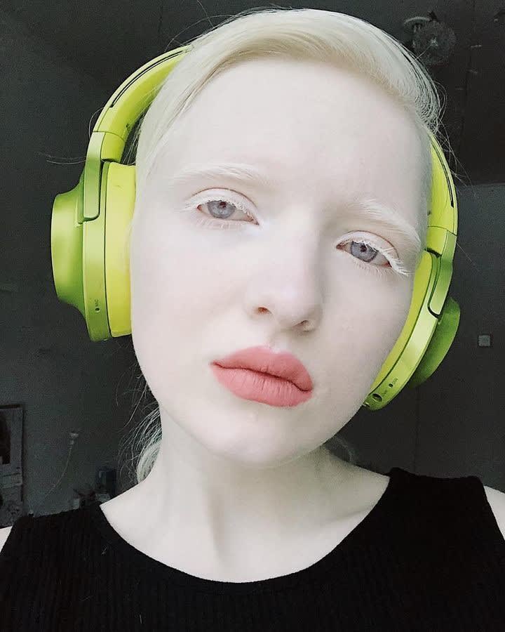 Albinism