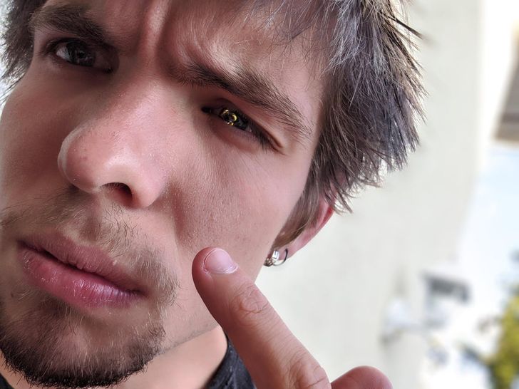 „O viespe a ajuns chiar în fața ochiului meu. Acum am un ochi de aur”