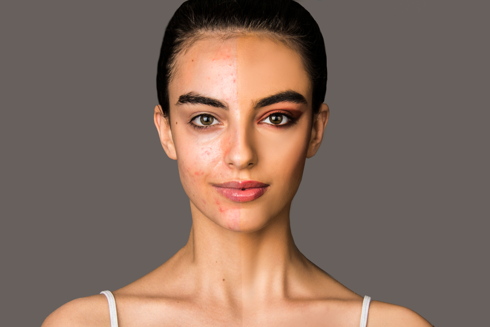 Produsele cosmetice contribuie la apariția acneei