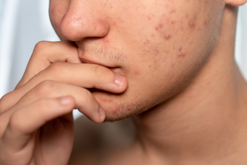 Stresul provoacă acnee