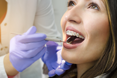 Aparatele dentare