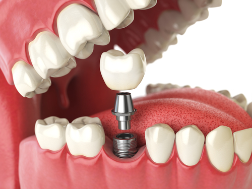 Implanturile dentare