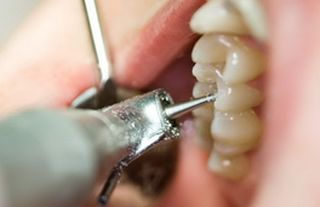 Cariile, efectul malpozitiilor dentare