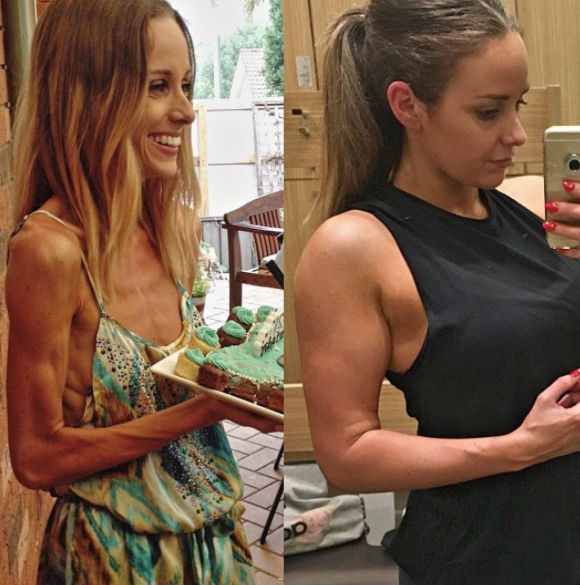 Inainte si dupa anorexie