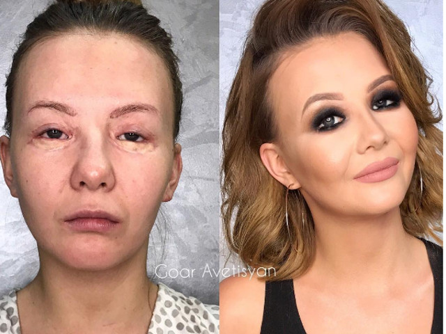 Cicatrice in jurul ochilor