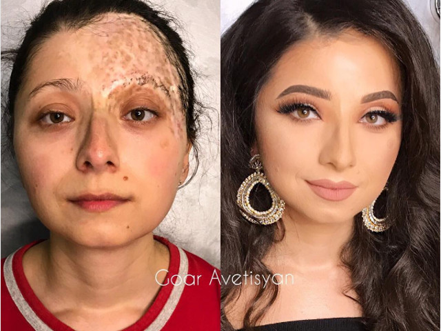 Cicatrice de mari dimensiuni