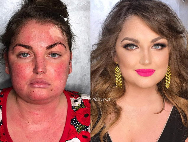 Ten foarte sensibil, cu imperfectiuni si cicatrice