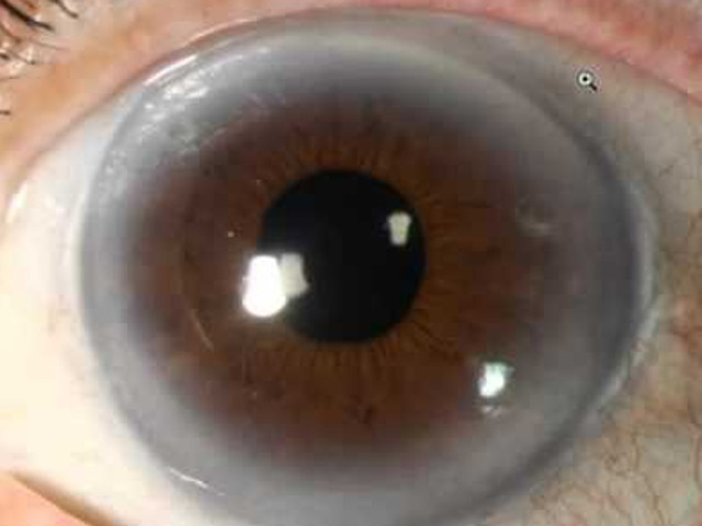 Un inel de culoare gri in jurul corneei indica un nivel crescut de colesterol in sange