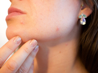 Trateaza acneea