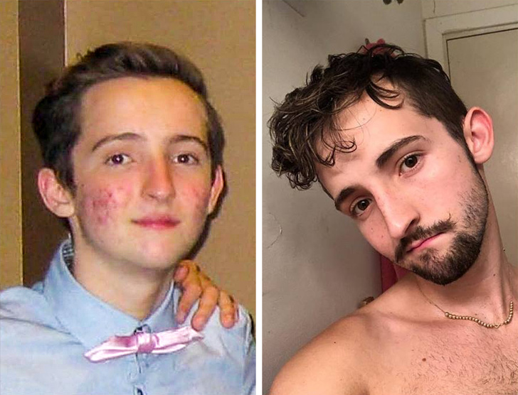 In sfarsit a scapat de acnee