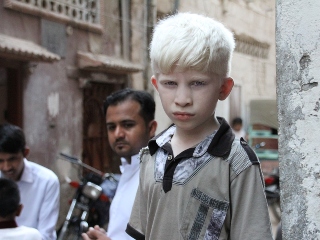 Sa ai albinism