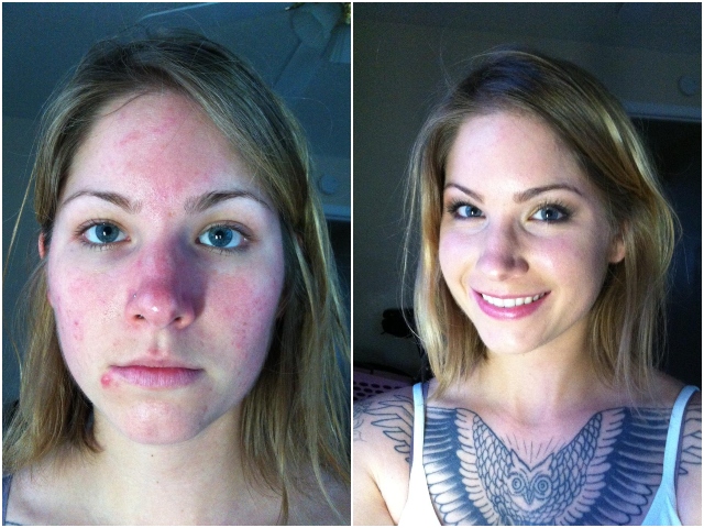 Si-a vindecat tenul, iar acum este mai increzatoare ca niciodata