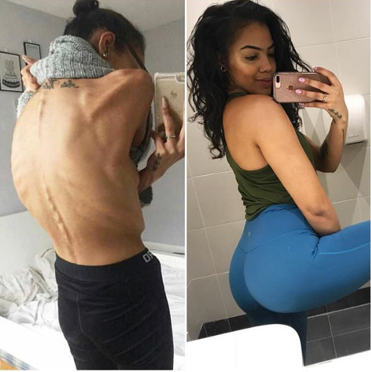 A reusit sa invinga problemele cu anorexia, iar acum este sanatoasa si mult mai fericita