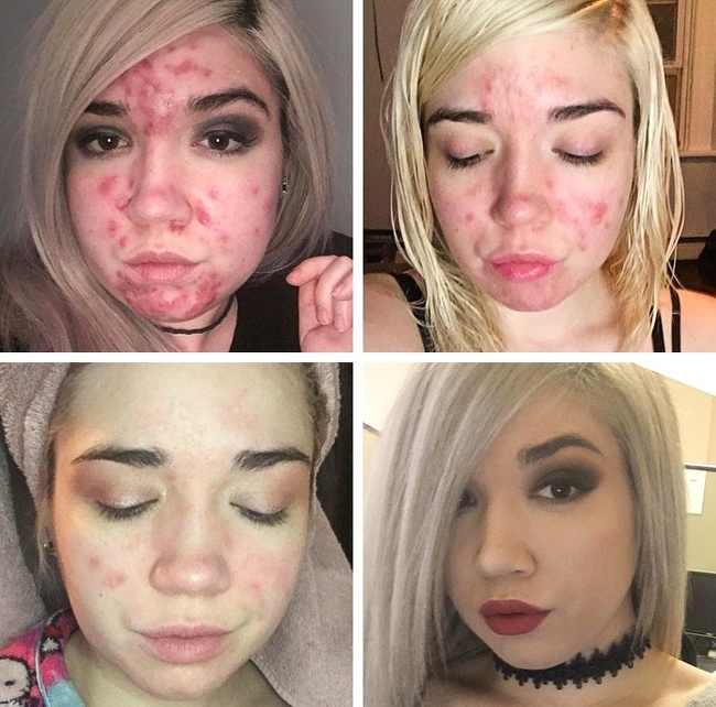 A reusit sa scape de acnee in 8 luni